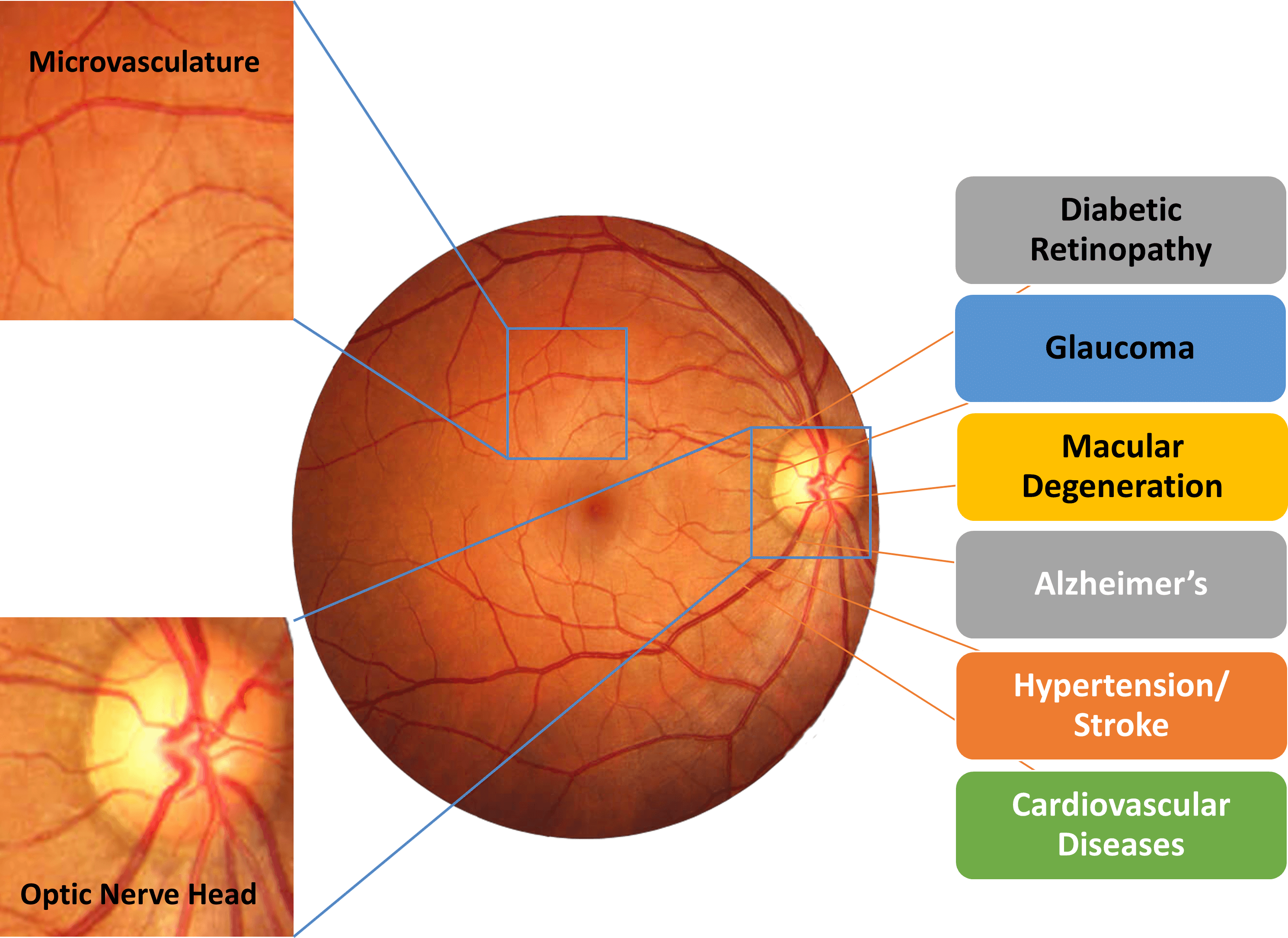 Retinal Diseases